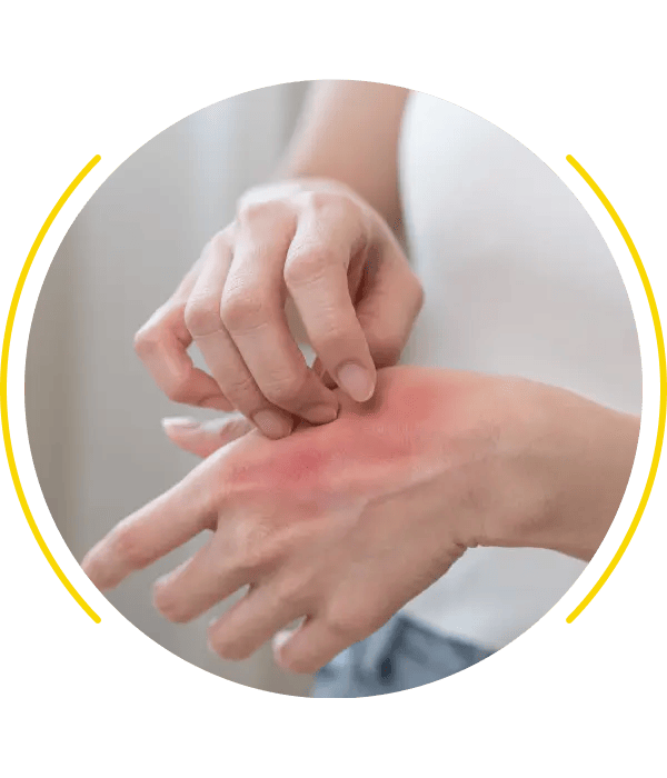 Person experiencing hand irritation and redness from an allergy.